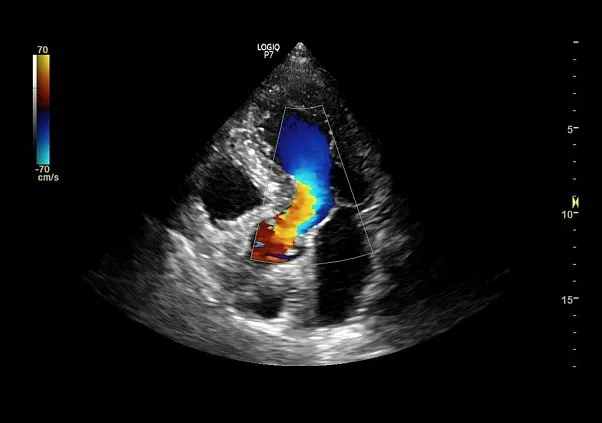 Клинические изображения Logiq P7 УЗИ аппарат GE