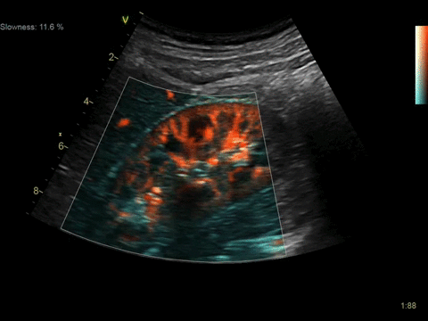 Клинические изображения Ультразвуковая диагностическая система GE Vivid S60