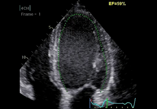 Клинические изображения Ультразвуковая диагностическая система GE Vivid S60
