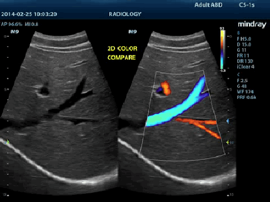 Клинические изображения УЗИ аппарат Mindray M9T портативный