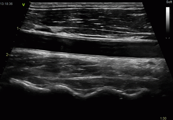 Клинические изображения УЗИ аппарат GE HealthCare Vivid E90