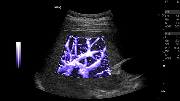 Клинические изображения GE HealthCare Logiq E10 ультразвуковая система