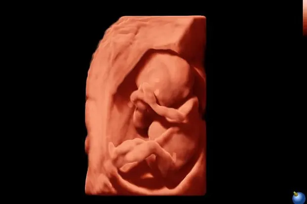 Клинические изображения Sonoscape S60 ультразвуковой аппарат