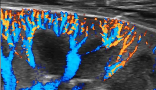 Клинические изображения Sonoscape S60 ультразвуковой аппарат