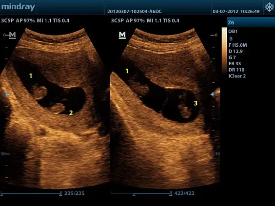 Клинические изображения УЗИ аппарат Mindray Z6 портативный