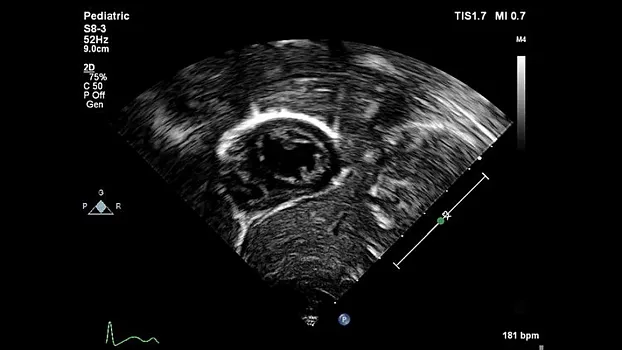 Клинические изображения Philips EPIQ 5 ультразвуковой аппарат