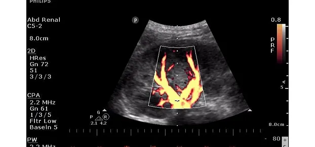 Клинические изображения Philips ClearVue 350 ультразвуковой аппарат