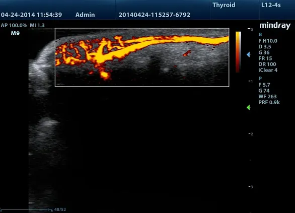 Клинические изображения УЗИ аппарат Mindray M8 портативный