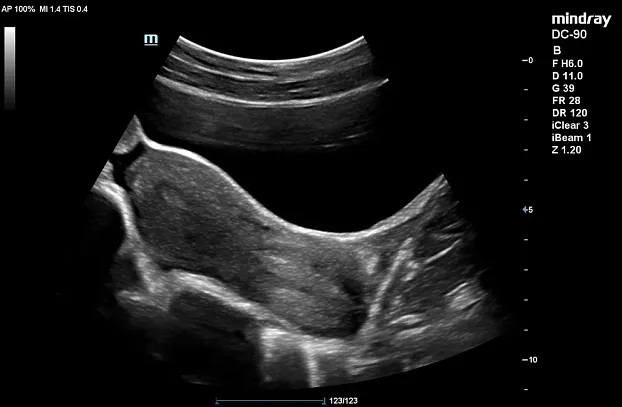 Клинические изображения УЗИ аппарат Mindray DC-90 Exp