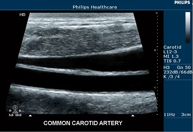 Клинические изображения Philips HD5 ультразвуковой аппарат