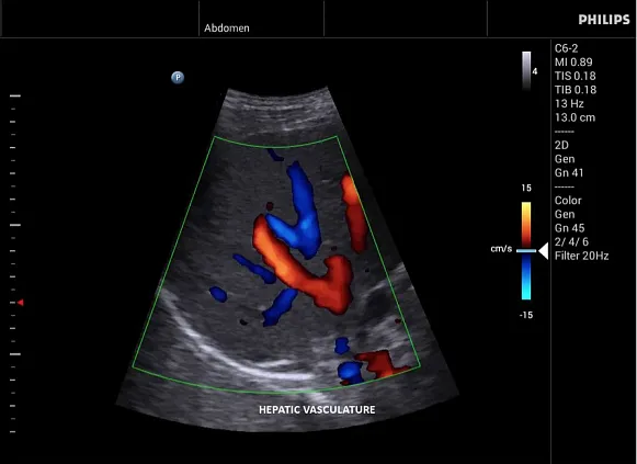 Клинические изображения Philips InnoSight ультразвуковой аппарат
