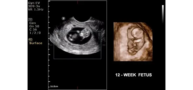 Клинические изображения Philips ClearVue 650 ультразвуковой аппарат