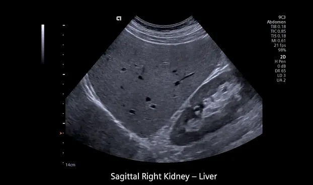 Клинические изображения Siemens Redwood аппарат УЗИ
