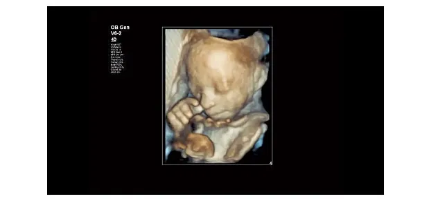 Клинические изображения Philips Affiniti 50 ультразвуковой аппарат