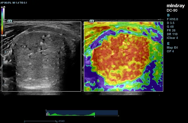 Клинические изображения УЗИ аппарат Mindray DC-90 X-Insight