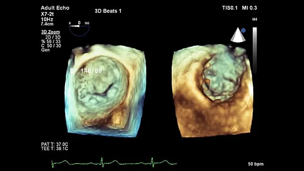 Клинические изображения Philips EPIQ 5 ультразвуковой аппарат
