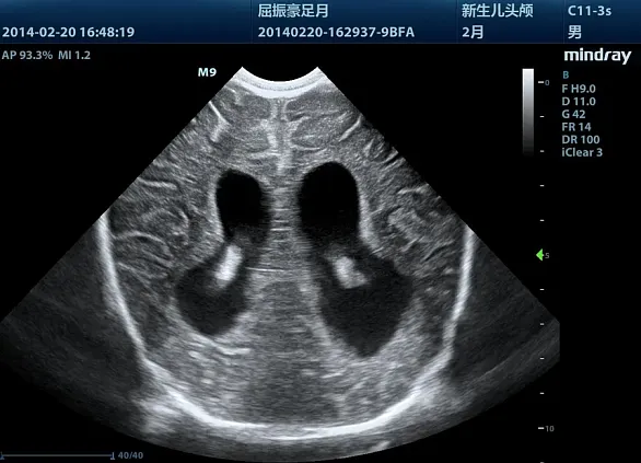 Клинические изображения УЗИ аппарат Mindray M8 портативный