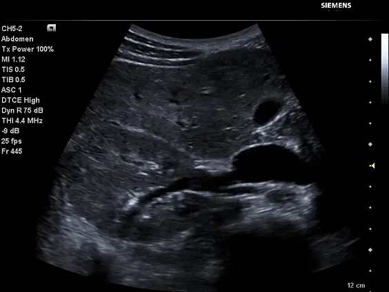 Клинические изображения Siemens Acuson P500 портативный аппарат УЗИ