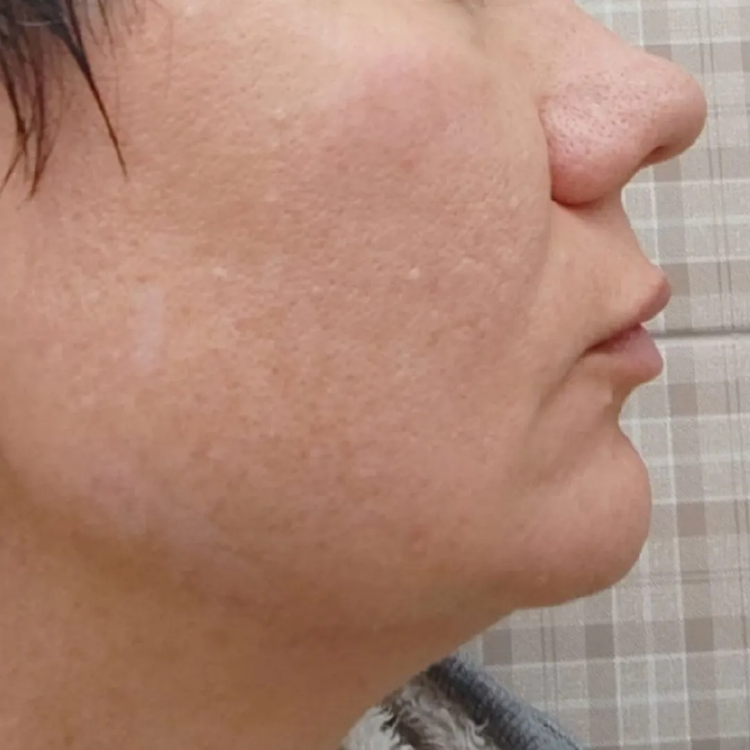 NeoGen омоложение лево после__.jpg NeoGen омоложение лево после__.jpg