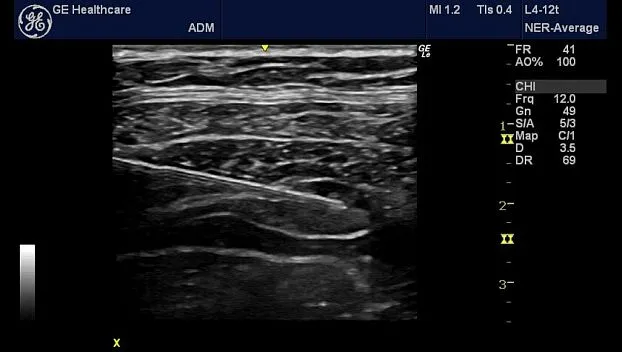 Клинические изображения Портативная ультразвуковая система GE HealthCare Logiq e