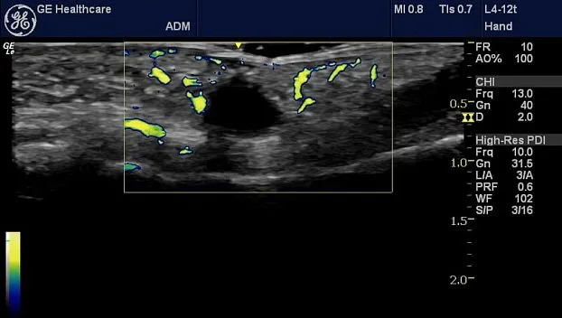Клинические изображения Портативная ультразвуковая система GE HealthCare Logiq e